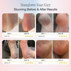 Dermave™ Electric Foot Callus Remover.