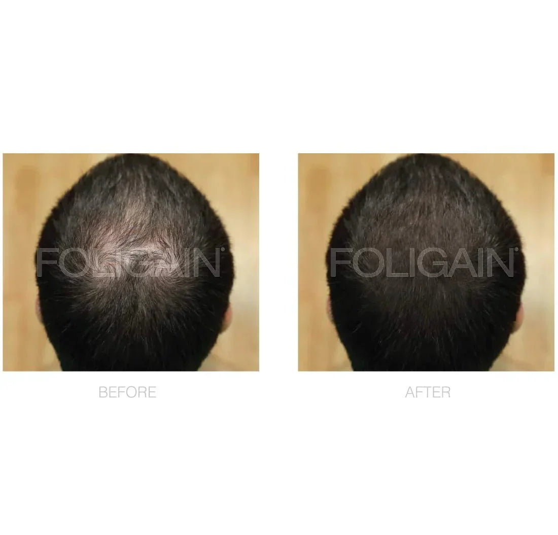 FOLIGAIN Minoxidil 5% Hair Regrowth Treatment For Men.